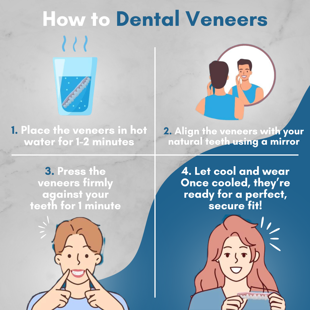 Perfect Dental Veneers